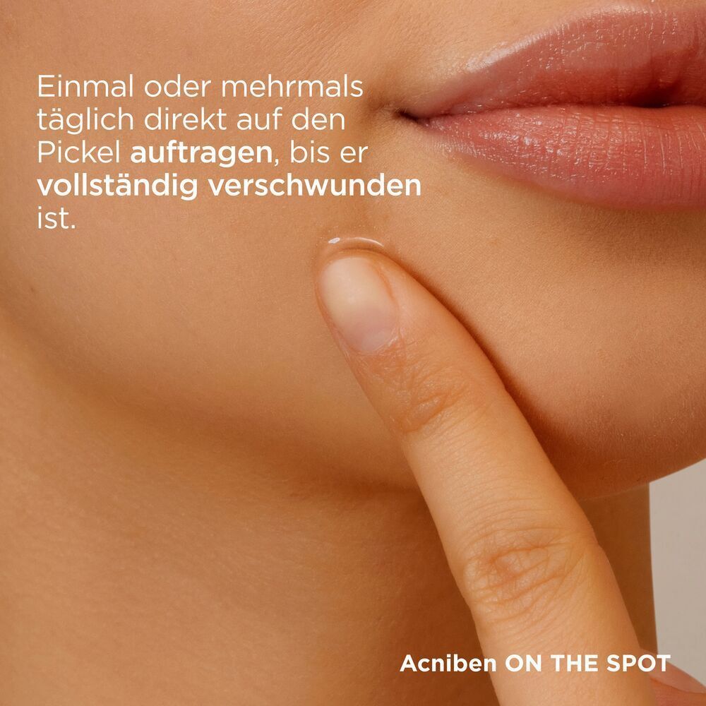 Finger trägt Gel auf Haut auf. Text: Acniben ON THE SPOT.