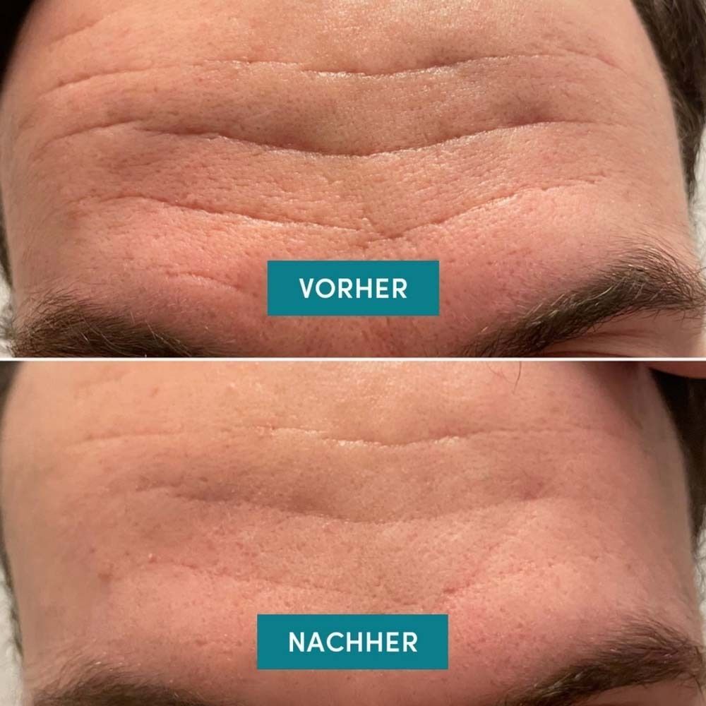Zwei Nahaufnahmen von Stirnen. Oben: Vorher. Unten: Nachher. Text in Türkis.