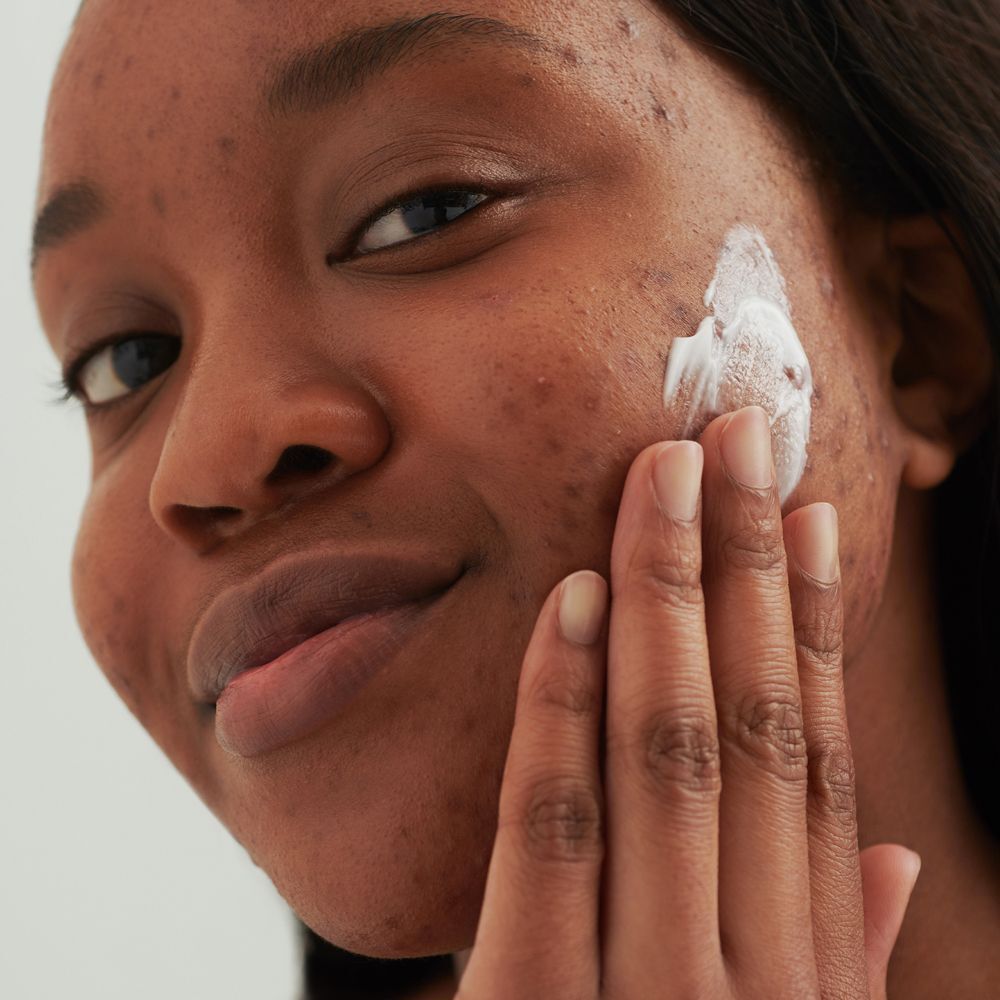 Eine Frau trägt DADO SENS PurDerm Waschcreme auf ihre unreine Haut auf.