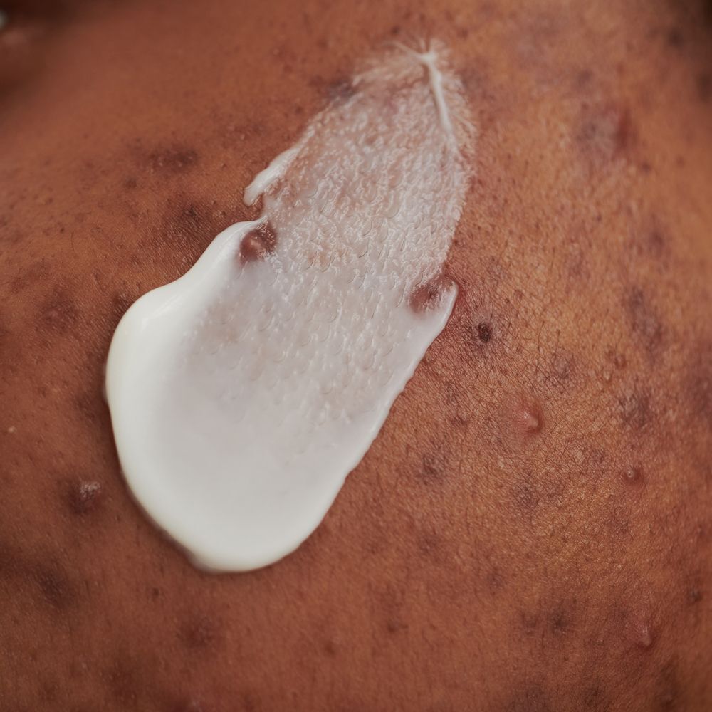 Ein Klecks DADO SENS PurDerm Waschcreme auf unreiner Haut.