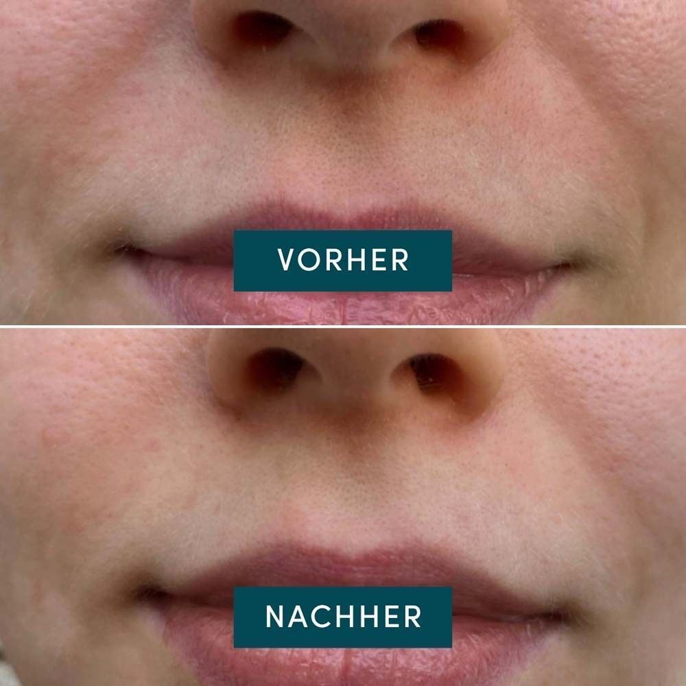 Vorher-Nachher-Vergleich von Lippen. Oben: Vorher. Unten: Nachher. Beide Bilder zeigen Lippen.