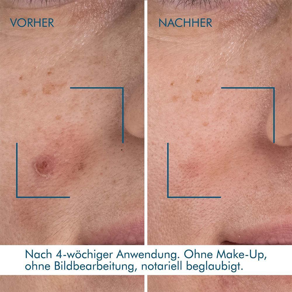 Vorher-Nachher-Vergleich von Haut. Text: Nach 4-wöchiger Anwendung. Ohne Make-Up, ohne Bildbearbeitung.
