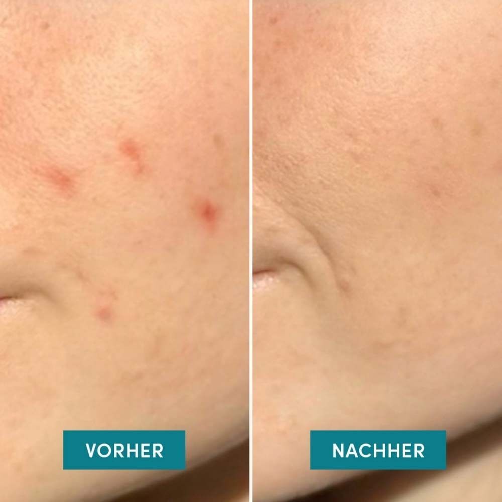 Zwei Nahaufnahmen von Hautpartien. Links: Haut mit Pickeln. Rechts: Haut nach der Behandlung. Text: Vorher/Nachher.