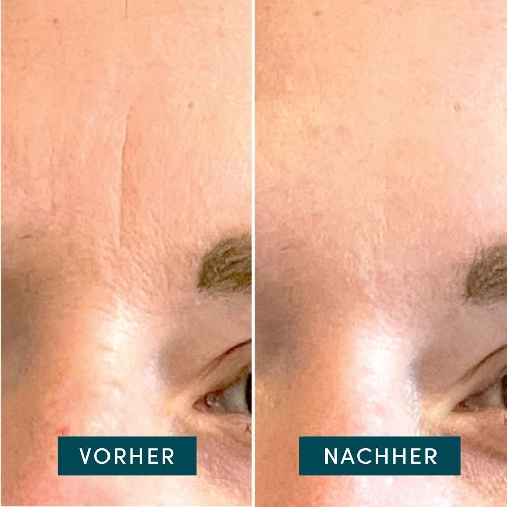 Vorher-Nachher-Vergleich. Nahaufnahme von Hautpartien. Links: Haut mit Falten. Rechts: Haut ohne Falten.