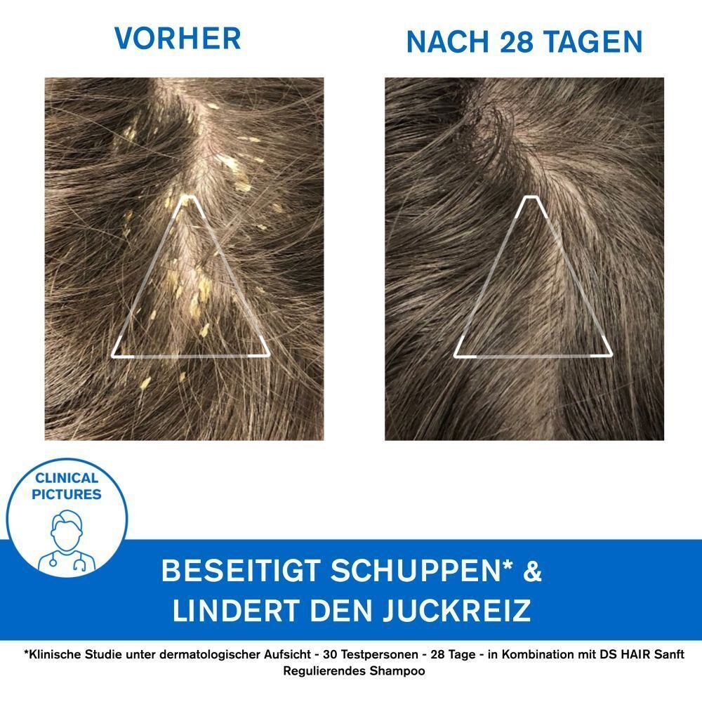 Vorher-Nachher-Vergleich von Kopfhaut mit Schuppen. Text: „Beseitigt Schuppen & lindert den Juckreiz“.