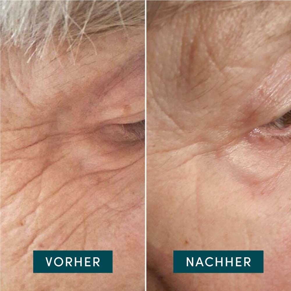 Vorher-Nachher-Vergleich. Links: Gesicht mit Falten. Rechts: Gesicht mit weniger Falten. Text: Vorher, Nachher.