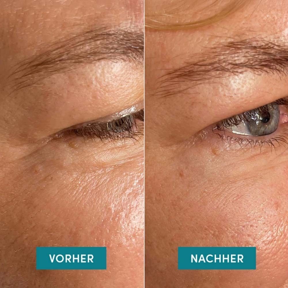 Vergleichsbild: Vorher-Nachher. Augenpartie mit Falten. Nachher: Haut wirkt glatter.