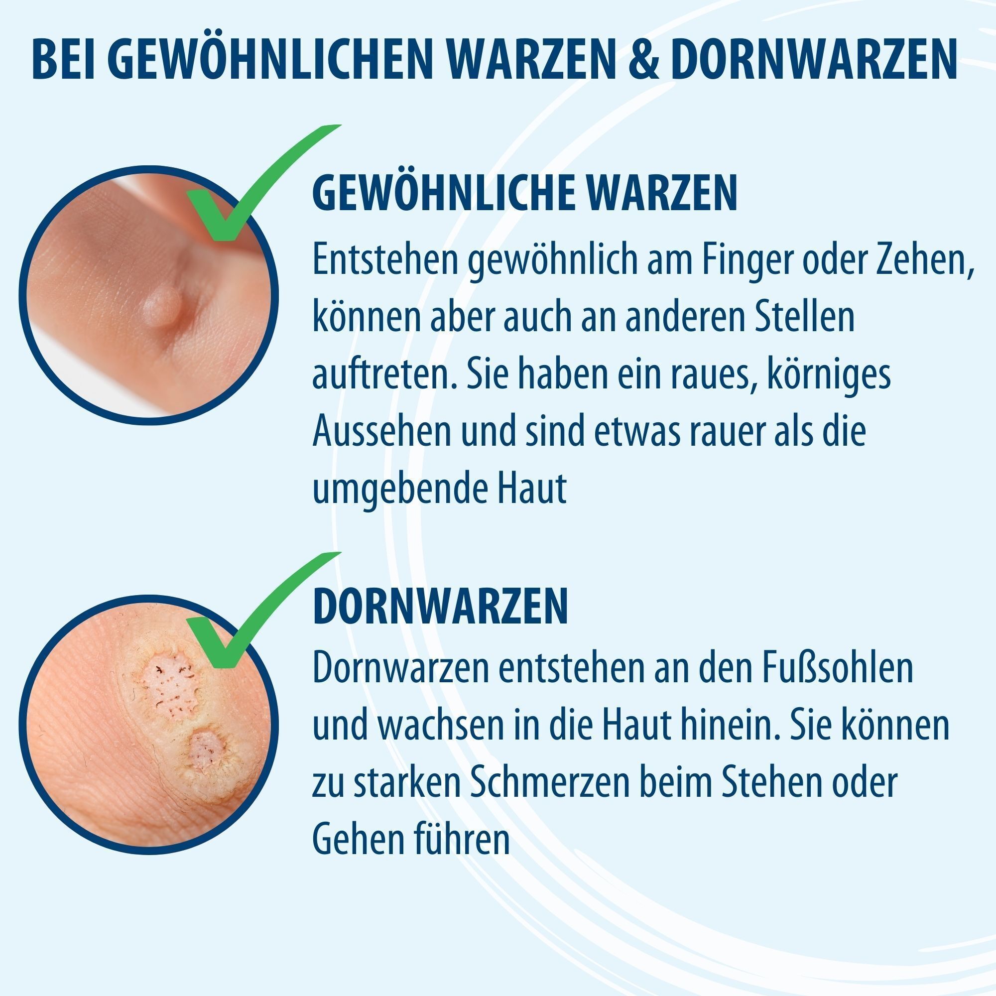 Text auf blauem Hintergrund. Gewöhnliche Warzen und Dornwarzen. Abbildungen von Warzen und Dornwarzen.