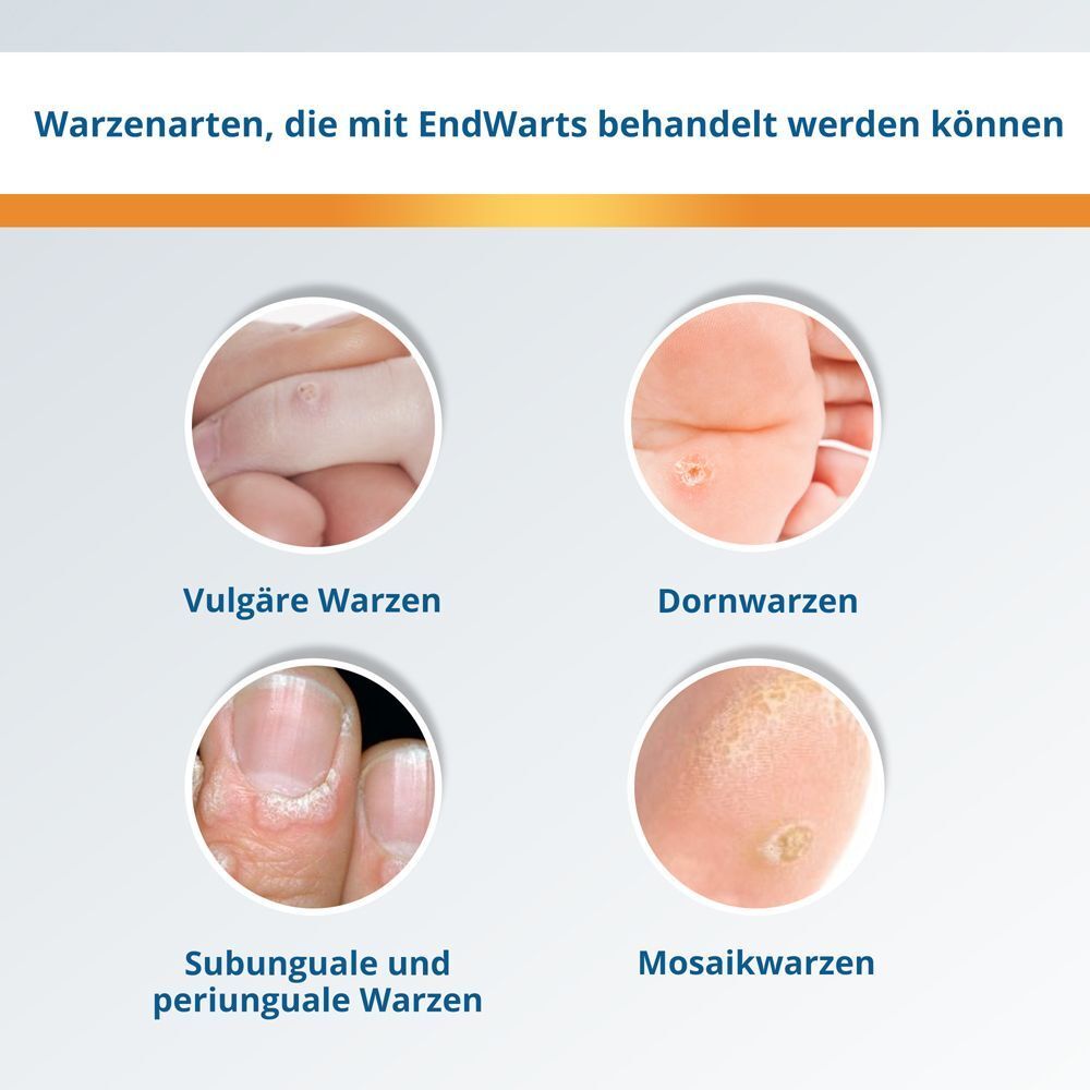 Infografik: Warzenarten, die mit EndWarts behandelt werden können. Bilder von verschiedenen Warzenarten.