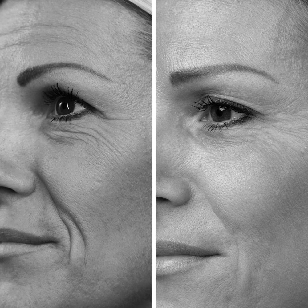 Vorher-Nachher-Vergleich. Gesicht einer Frau mit Falten, dann Gesicht mit weniger Falten. Schwarz-Weiß-Aufnahme.