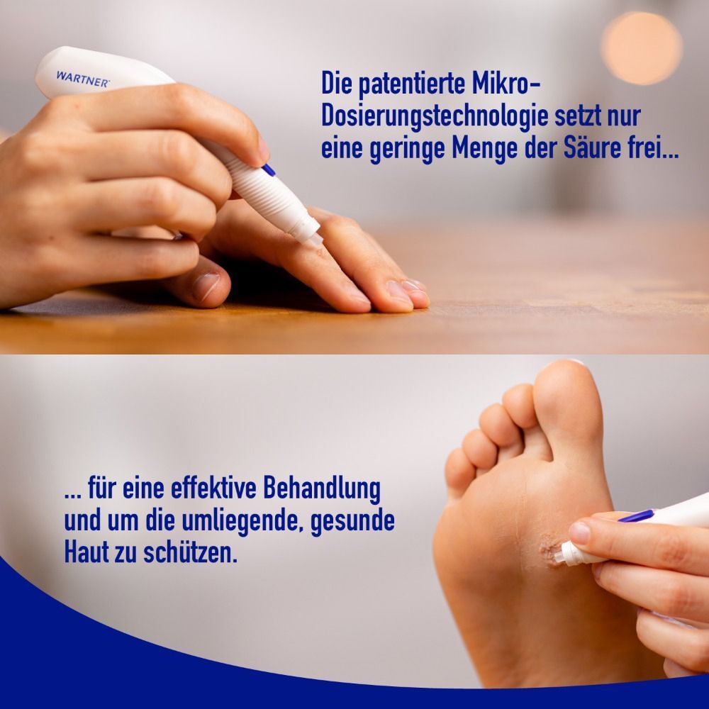 Zwei Bilder. Oben: Hand mit Stift. Unten: Fuß mit Warze. Text: Die patentierte Mikro-Dosierungstechnologie setzt nur eine geringe Menge der Säure frei.
