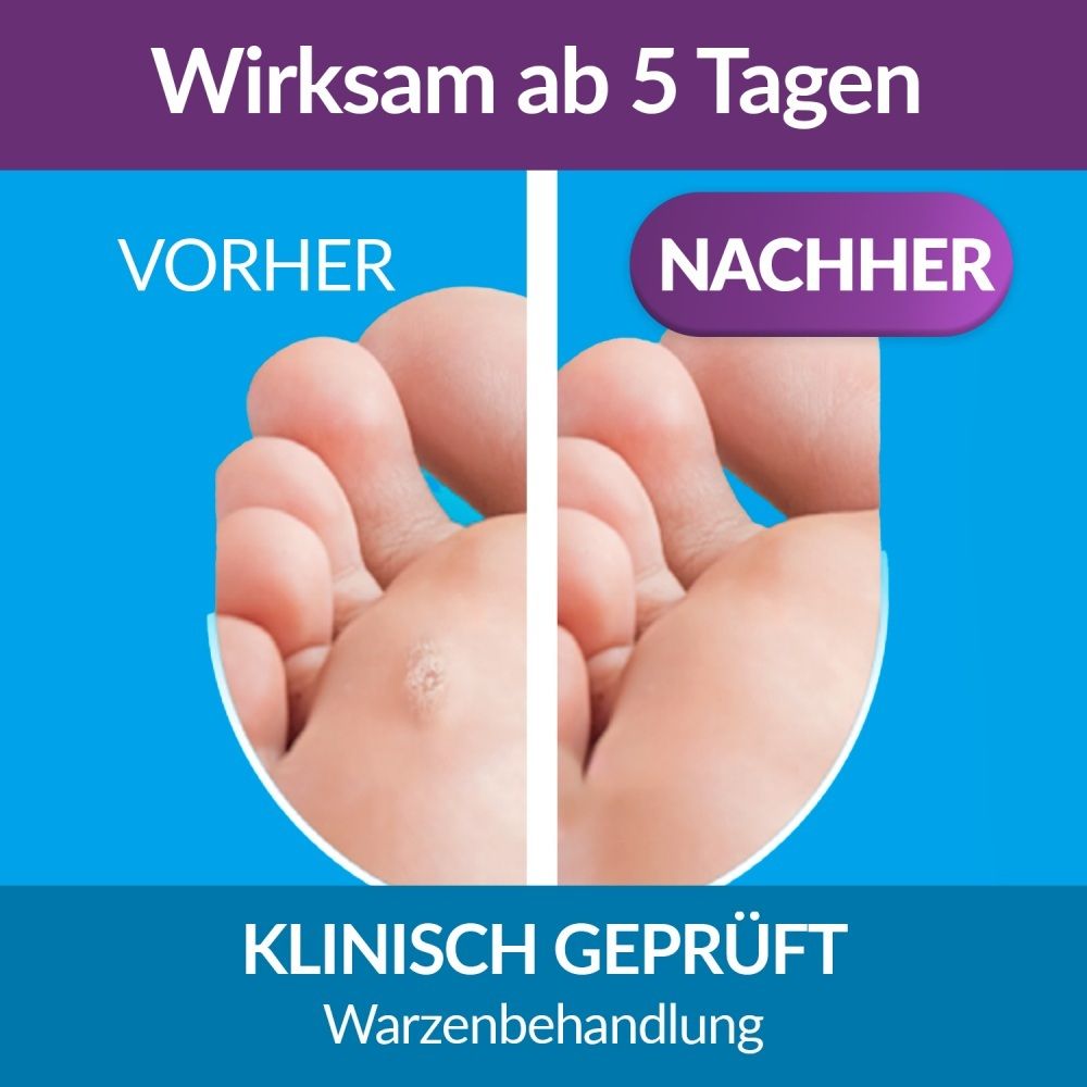 Vorher-Nachher-Vergleich einer Warzenbehandlung am Fuß mit Excilor®.
