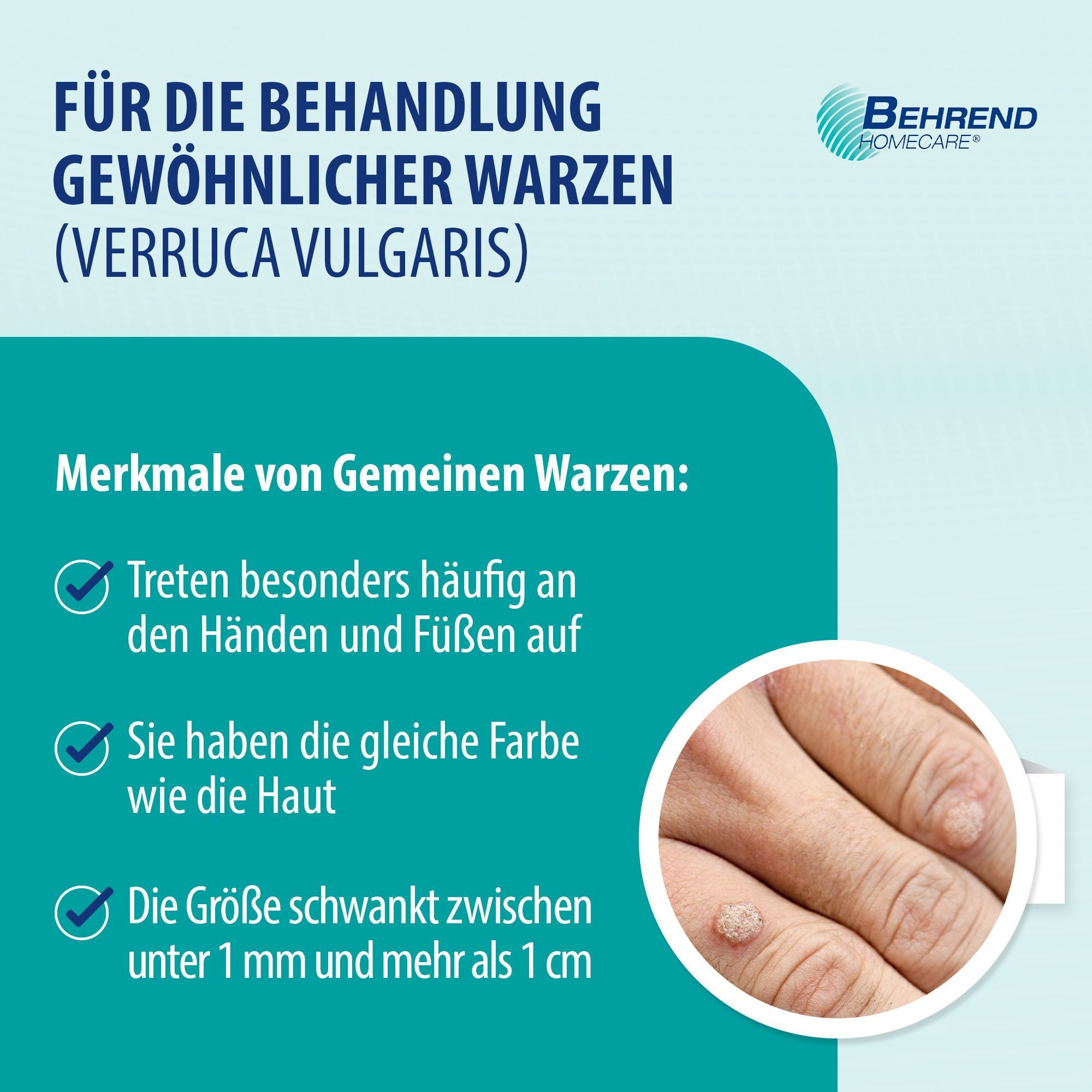 Infografik mit Informationen über gewöhnliche Warzen. Text und Illustrationen zeigen Merkmale und Eigenschaften von Warzen.