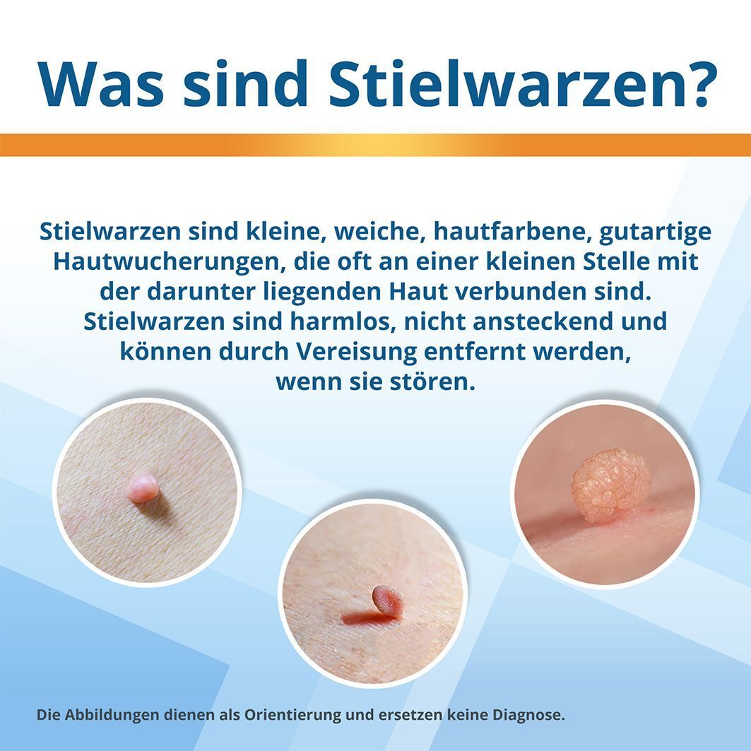Text: Was sind Stielwarzen? Drei Hautabbildungen mit Stielwarzen. Text und Illustrationen.
