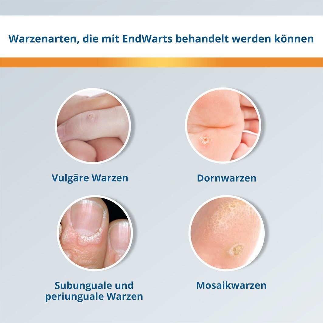 Nahaufnahmen von Warzenarten: Vulgäre, Dorn-, Subunguale und Mosaikwarzen. Beschriftungen unter den Bildern.