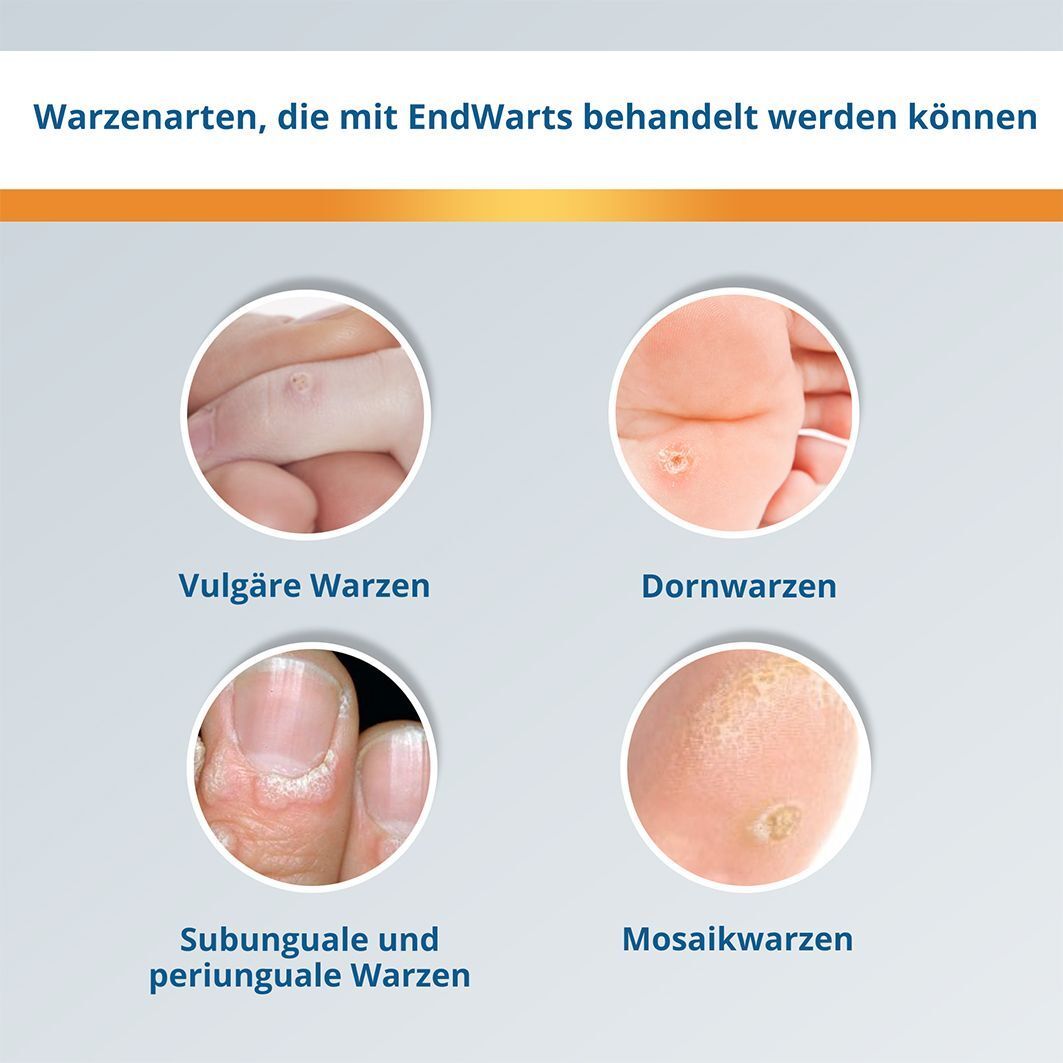 Abbildungen von Warzenarten: Vulgar, Dornwarzen, subunguale und periunguale Warzen, Mosaikwarzen. Auf blauem Hintergrund.