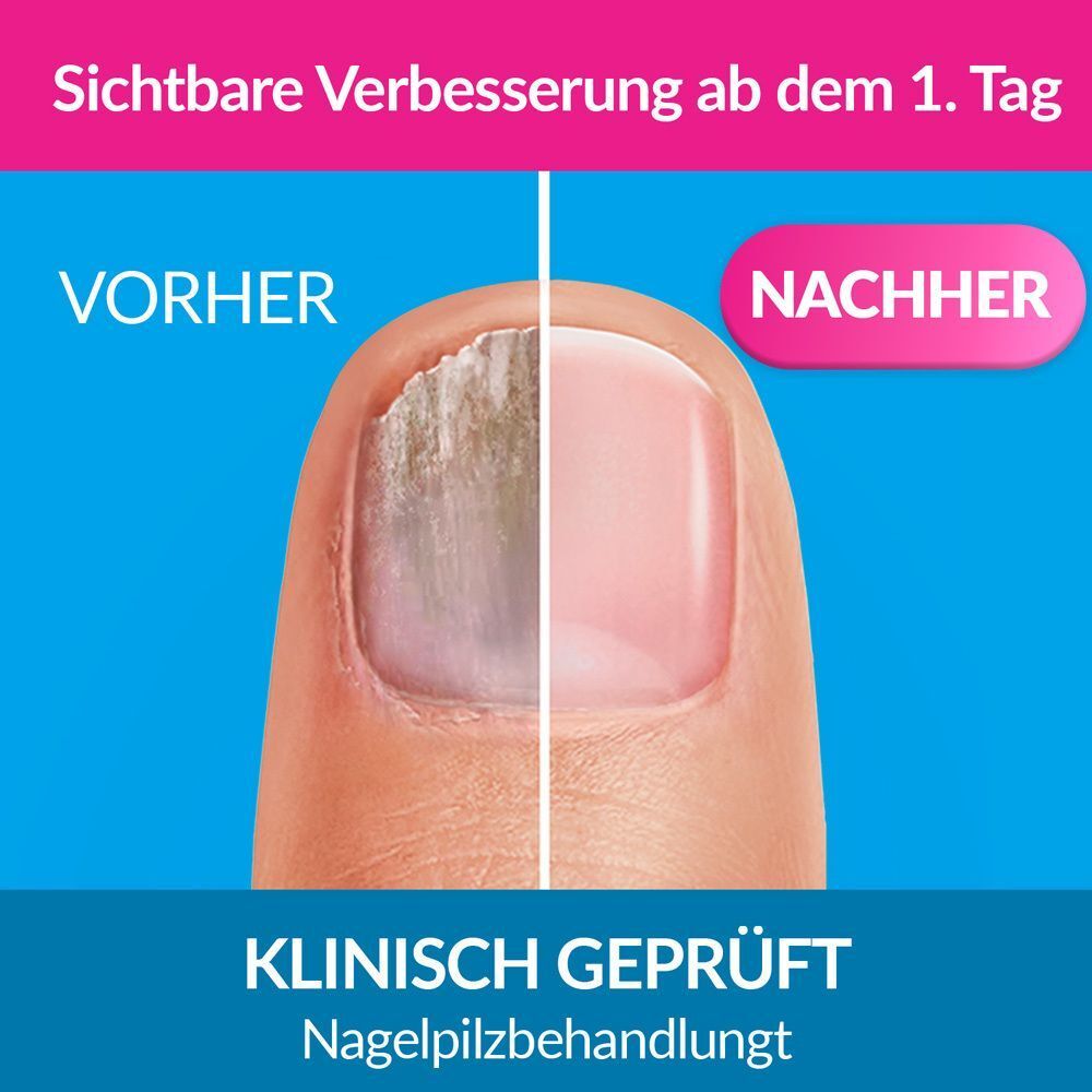 Nagel mit Nagelpilz, Vergleich Vorher/Nachher. Text: Sichtbare Verbesserung ab dem 1. Tag. Klinisch geprüft. Nagelpilzbehandlung.