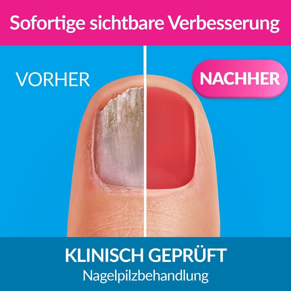 Nagel mit Nagelpilz, Vergleich Vorher/Nachher. Nagel nach Behandlung rot gefärbt. Text: Klinisch geprüft, Nagelpilzbehandlung.