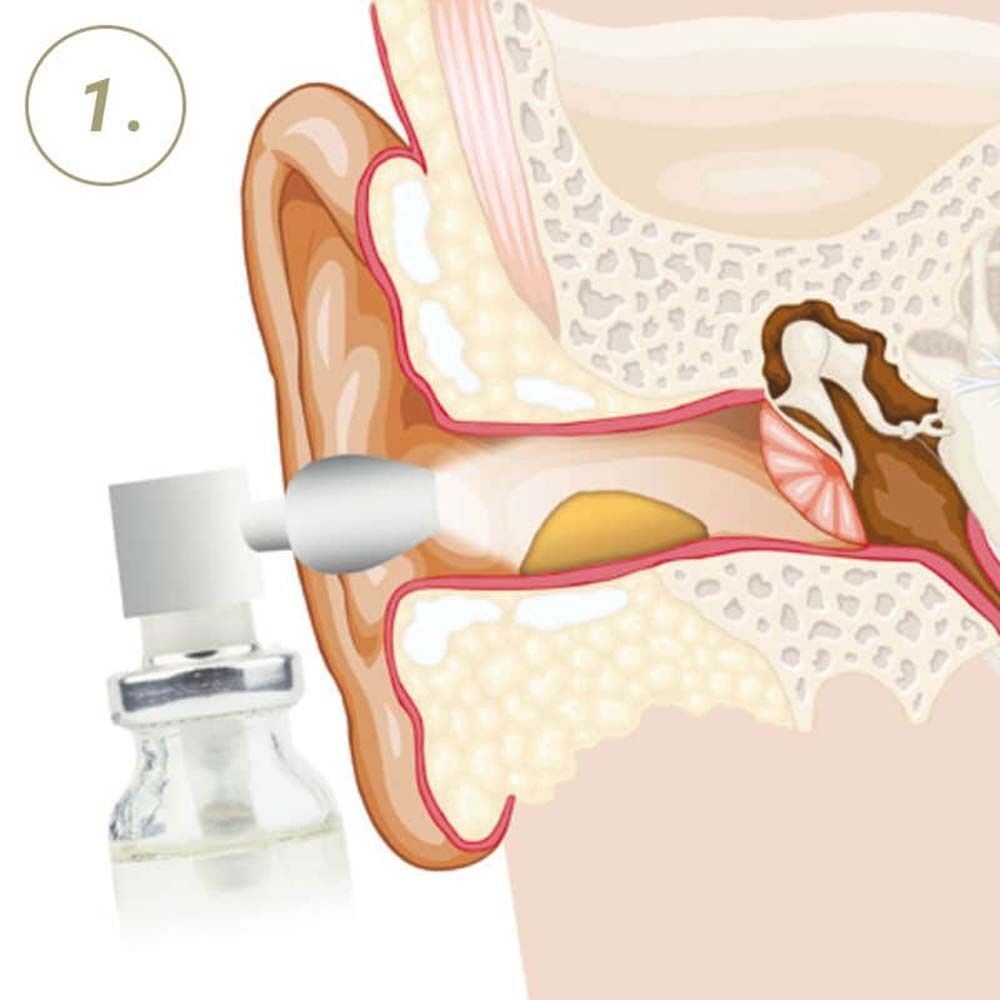 Illustration: Ohr mit Sprühkopf. Der Strahl des Sprays trifft auf Ohrenschmalz.