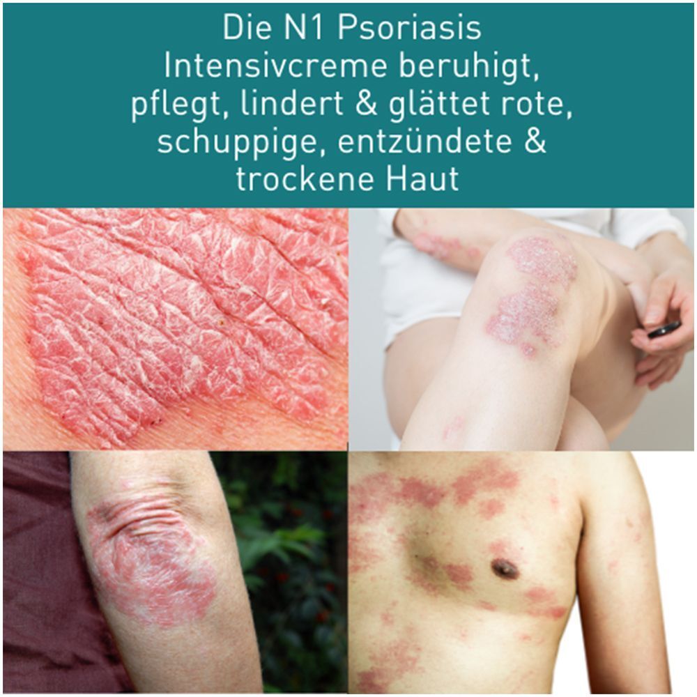 Collage von Hautpartien mit Psoriasis. Text: Die N1 Psoriasis Intensivcreme beruhigt, pflegt, lindert & glättet rote, schuppige Haut.