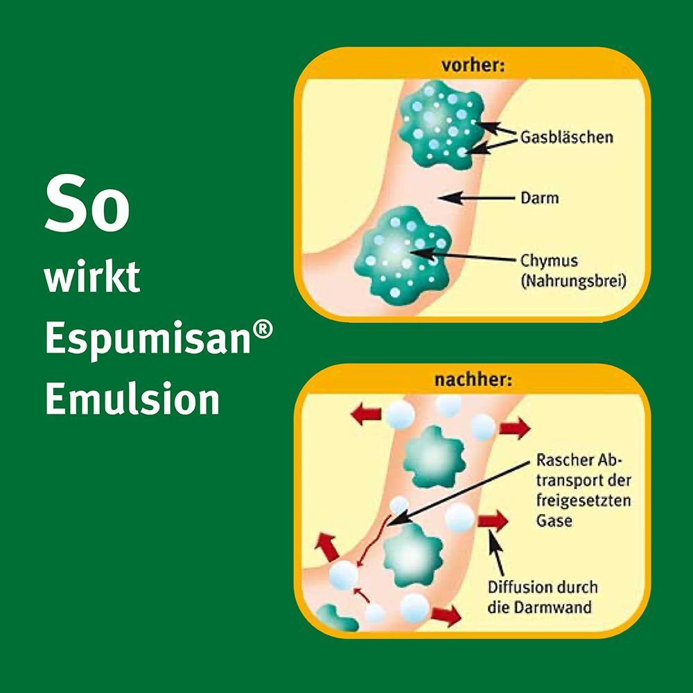 Schema: Wie Espumisan Emulsion wirkt – Gasbläschen im Darm vor und nach der Anwendung.