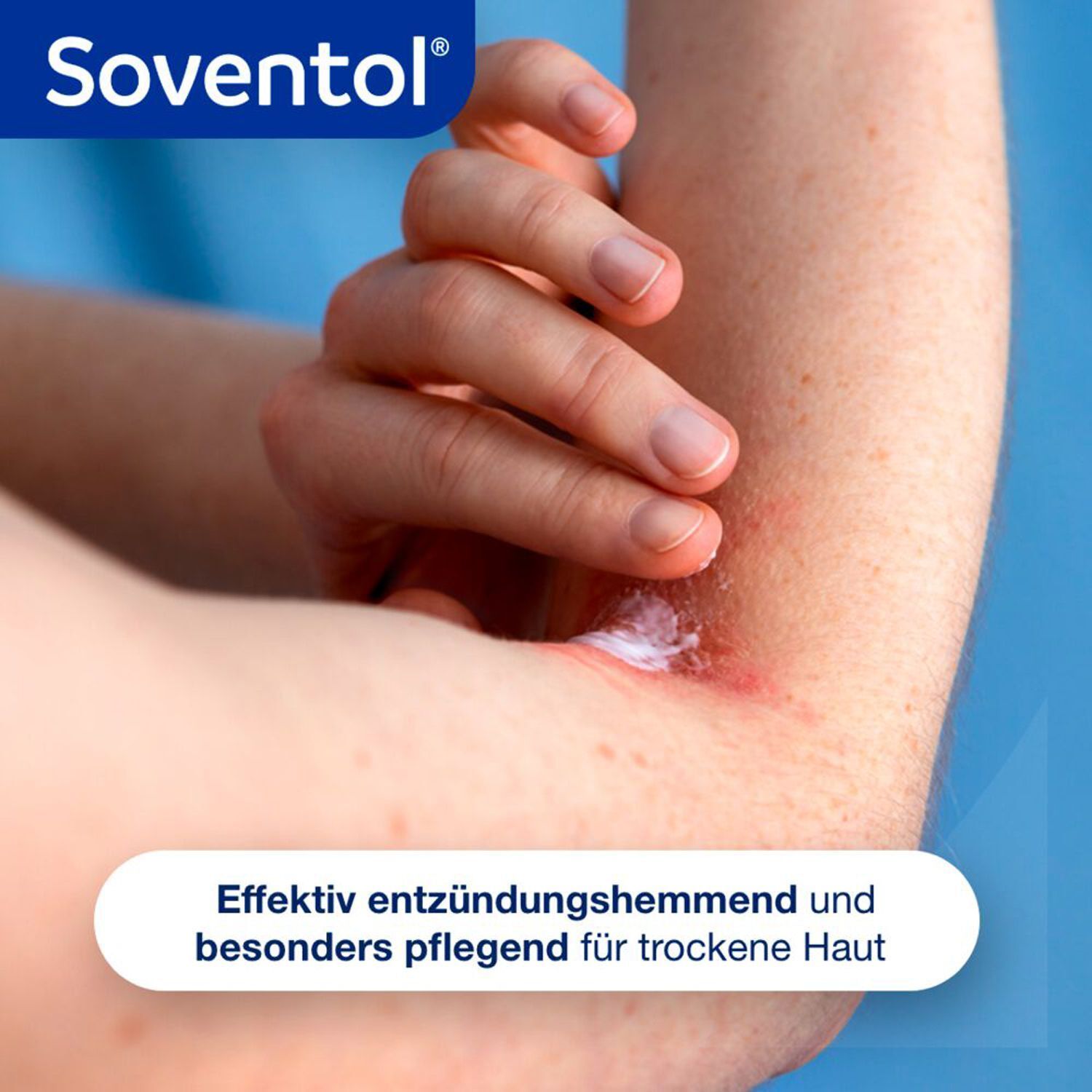 Eine Hand trägt Soventol Hydrocort 0,5% Creme auf einen entzündeten Arm auf.
