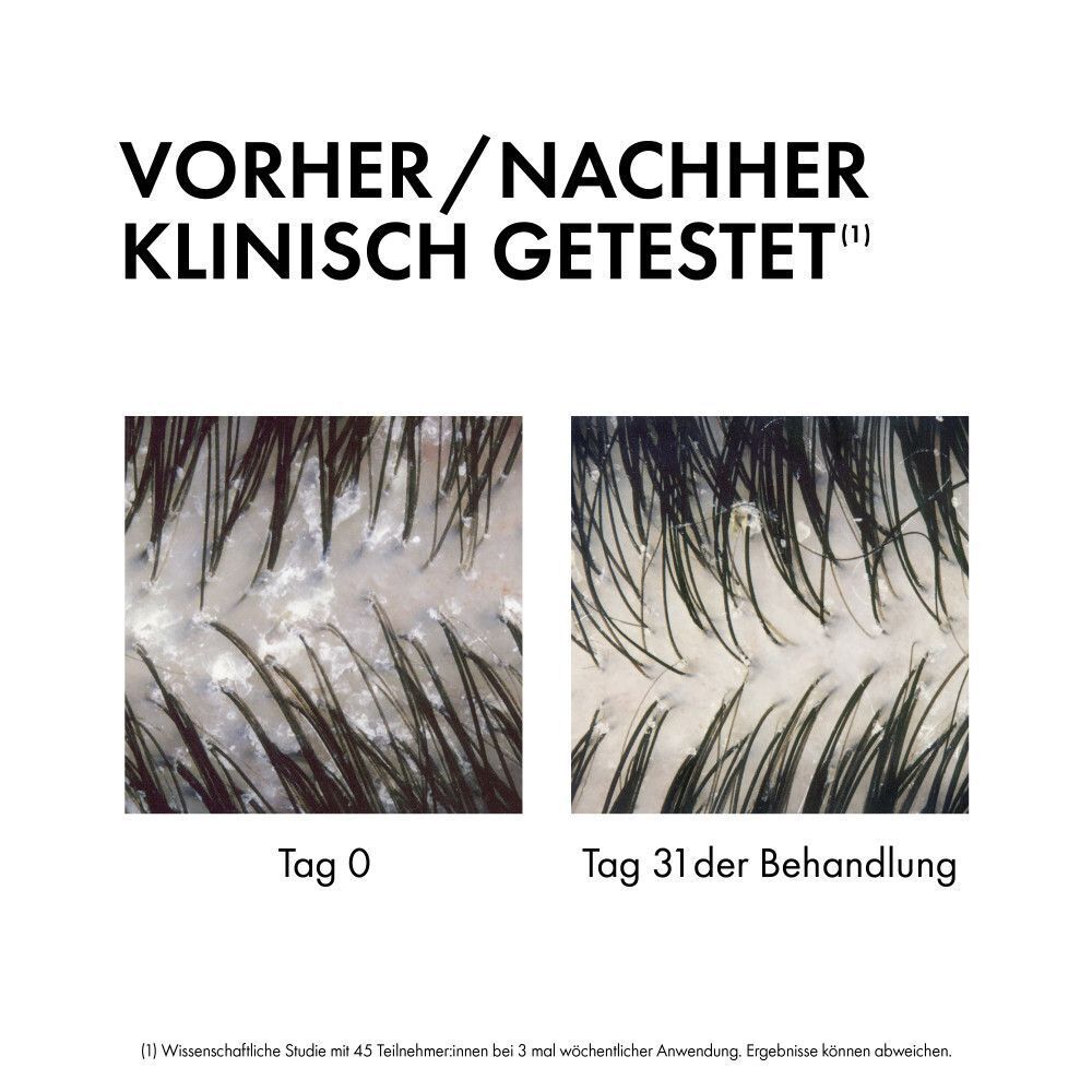 Klinische Vorher/Nachher-Bilder der Kopfhaut. Links 'Tag 0', rechts 'Tag 31 der Behandlung', zeigt reduzierte Schuppenbildung.