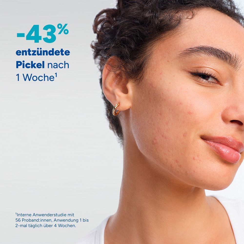 Porträt einer Frau mit unreiner Haut, die eine Reduzierung von Pickeln zeigt.