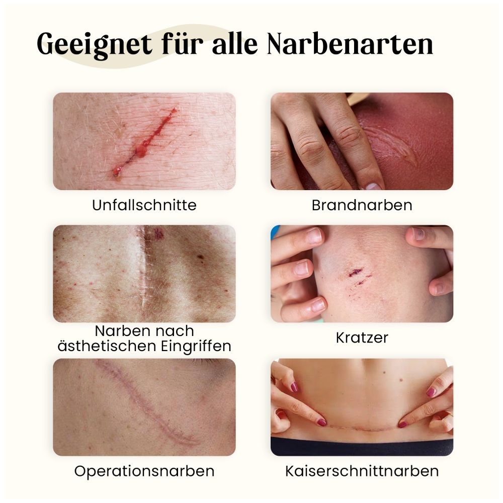 Dermatix Ultra Gel ist geeignet für alle Narbenarten: Unfall-, Brand-, Operations-, Kratzer-, ästhetische Narben.