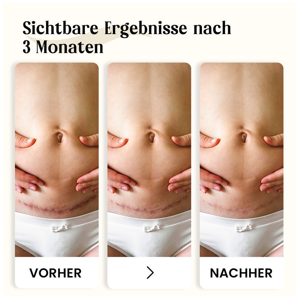 Vorher-Nachher-Vergleich von Narben nach 3 Monaten Behandlung mit Dermatix Ultra Gel.