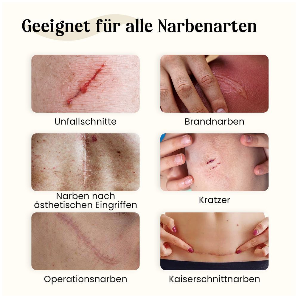 Geeignet für alle Narbenarten: Unfall-, Brand-, Operations-, Kratzer-, ästhetische Eingriffs- und Kaiserschnittnarben.