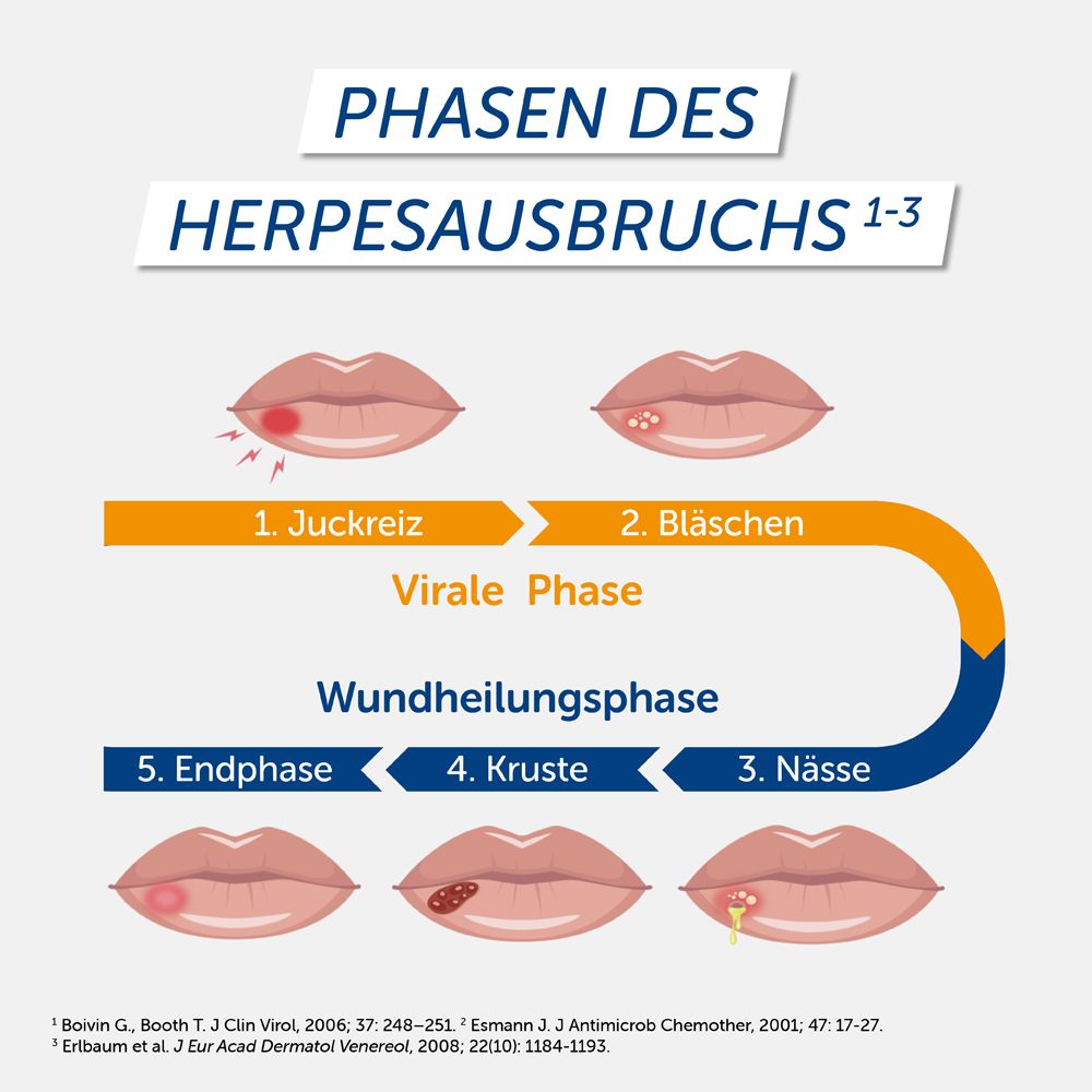Grafik zeigt Phasen des Herpesausbruchs. 5 Stadien mit Bildern von Lippen. Texte in Deutsch.