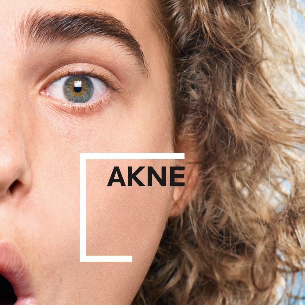 Nahaufnahme eines Gesichts. Text: AKNE. Hautunreinheiten im Gesicht.