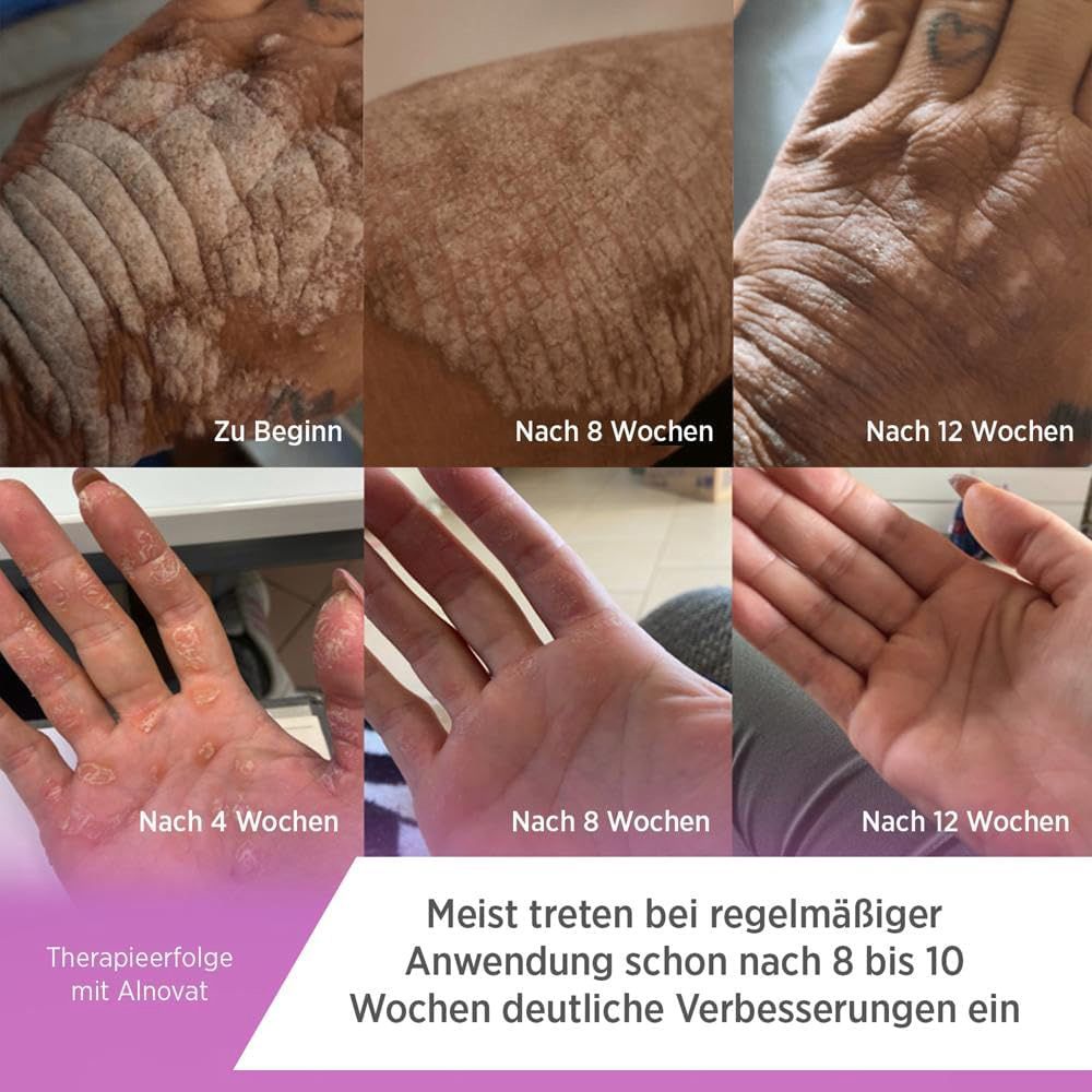 Vorher-Nachher-Bilder von Hautbehandlung mit Alnovat Creme über 12 Wochen. Deutliche Verbesserung sichtbar.