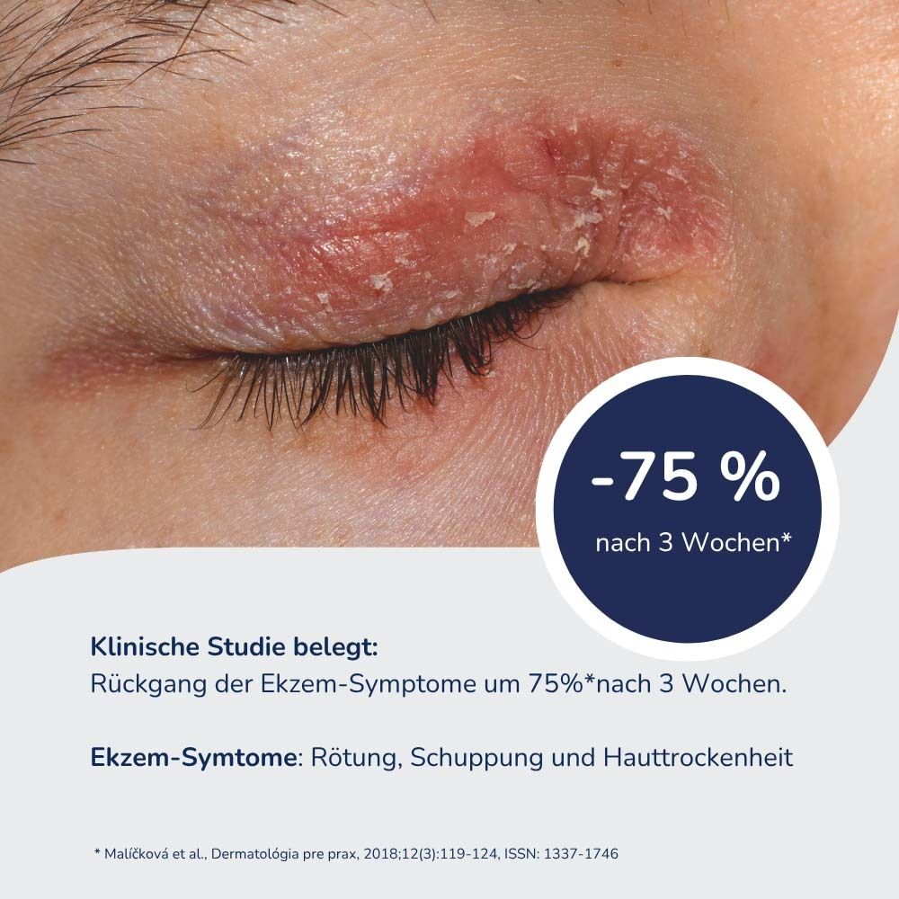 Auge mit Ekzemsymptomen. Text: -75% nach 3 Wochen. Klinische Studie belegt Rückgang der Ekzem-Symptome.