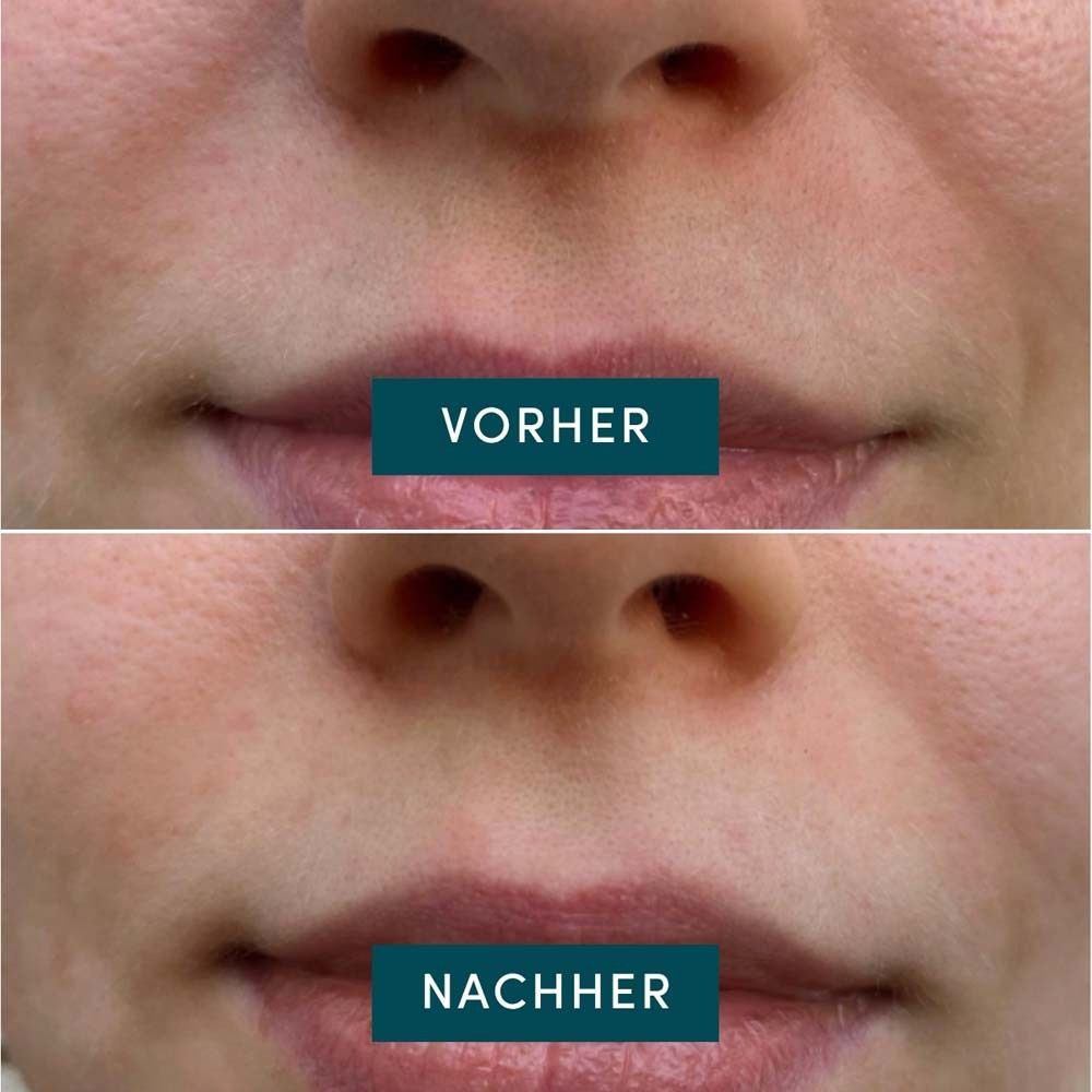 Vorher-Nachher-Vergleich von Lippen. Obere Reihe: Vorher. Untere Reihe: Nachher. Text in blauer Box.