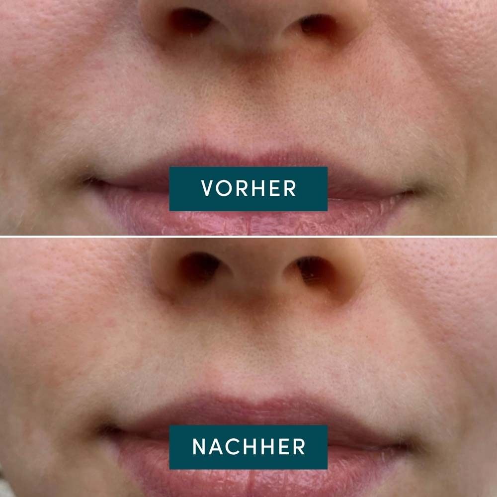Vorher-Nachher-Vergleich. Obere Lippenpartie: Vorher. Untere Lippenpartie: Nachher.