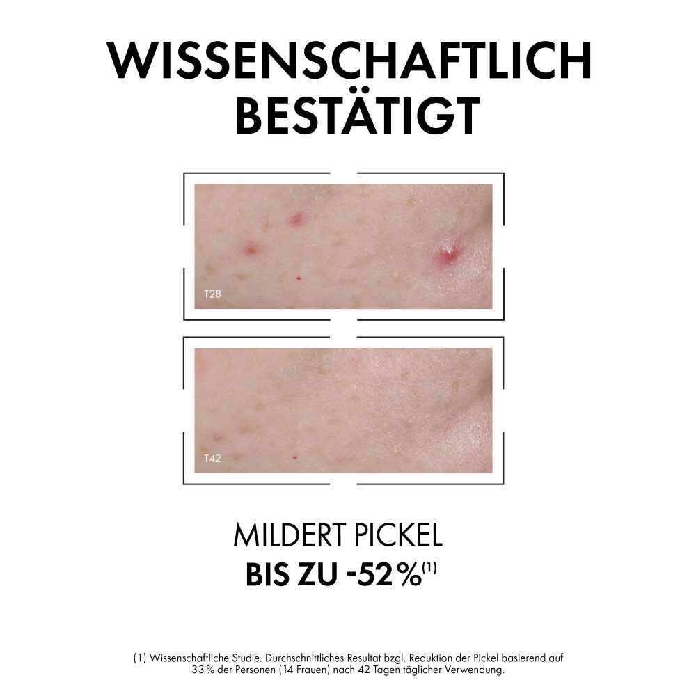 Vorher-Nachher-Bilder. Text: Mildert Pickel bis zu -52%. Wissenschaftlich bestätigt.