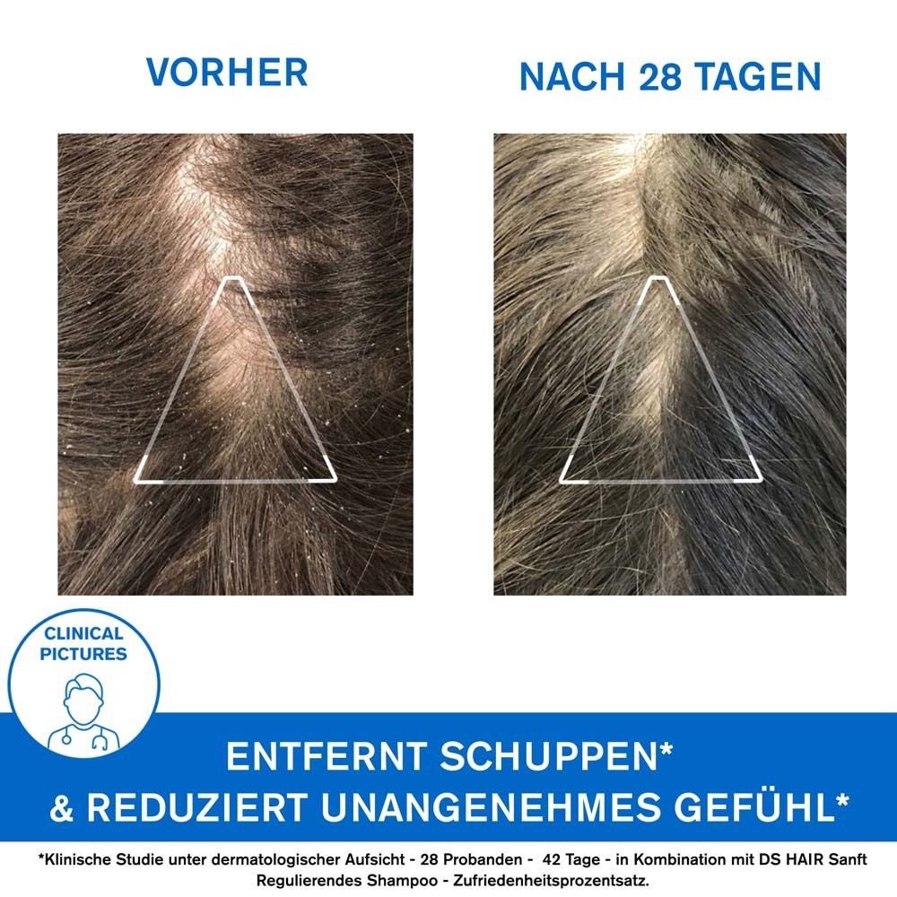 Vorher-Nachher-Vergleich. Kopfhaut mit Schuppen, dann weniger. Text: Entfernt Schuppen & reduziert unangenehmes Gefühl.