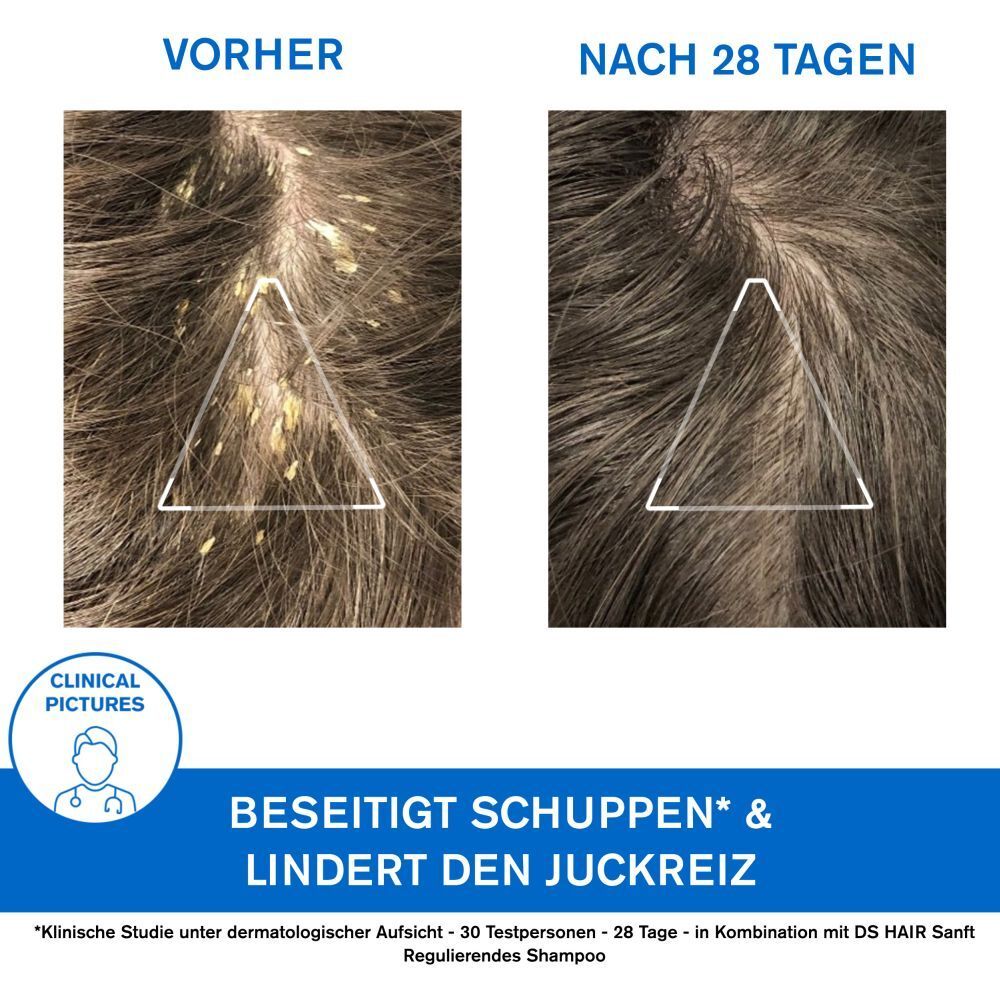 Vorher-Nachher-Vergleich von Kopfhaut mit Schuppen. Text: 'Beseitigt Schuppen & lindert den Juckreiz'.