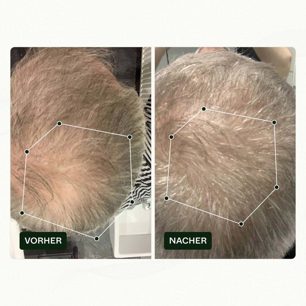 Vorher-Nachher-Vergleich. Kopfhautansicht. Haare vor und nach der Behandlung. Sechseckige Markierungen.