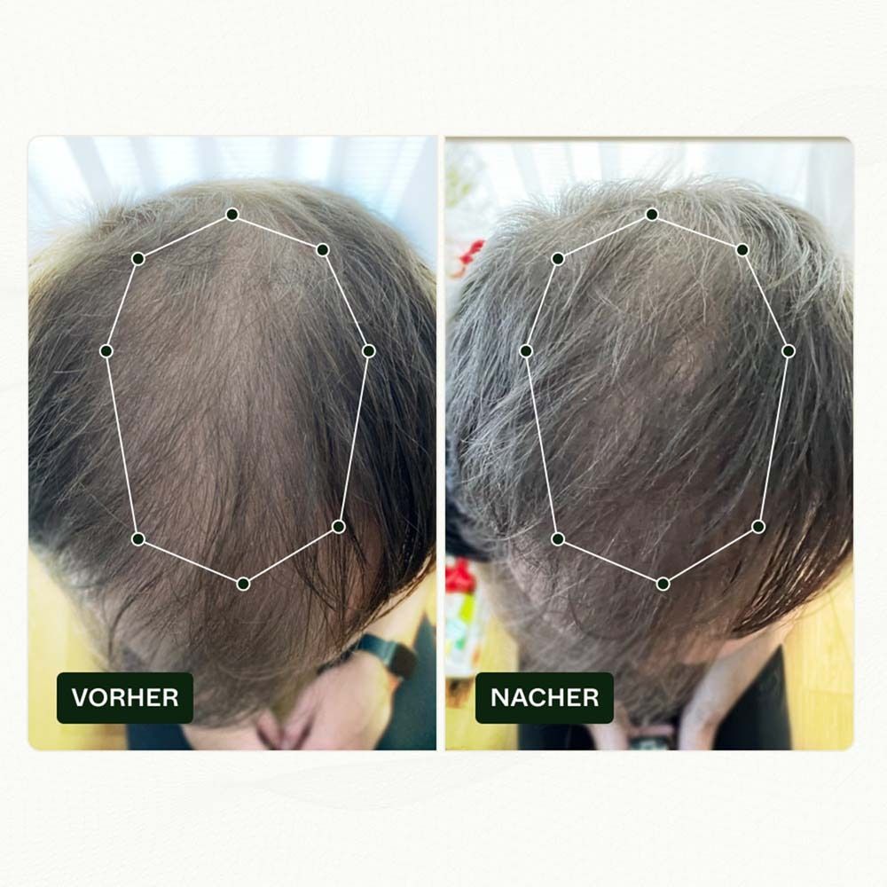Vorher-Nachher-Vergleich. Kopfhautansicht. Haare vor und nach der Behandlung. Achteckige Markierungen.