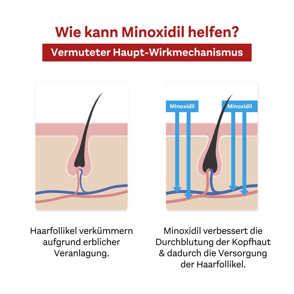 Grafik: Wie Minoxidil helfen kann. Darstellung von Haarfollikeln und Wirkung von Minoxidil.