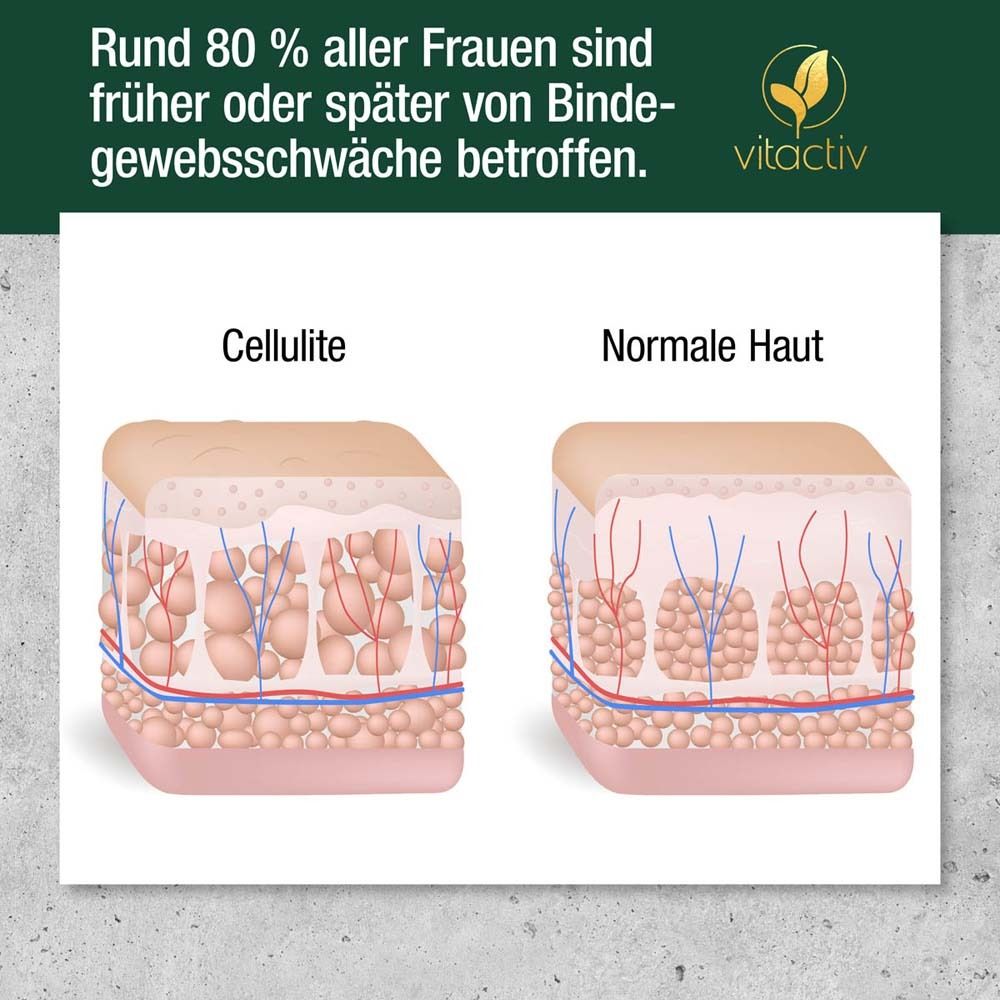 Vergleich von Cellulite und normaler Haut. Illustration der Hautschichten.