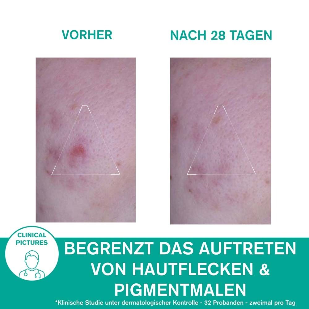 Comparaison avant-après. Peau avec imperfections. Texte : Limite les taches cutanées et les marques pigmentaires. Images cliniques.