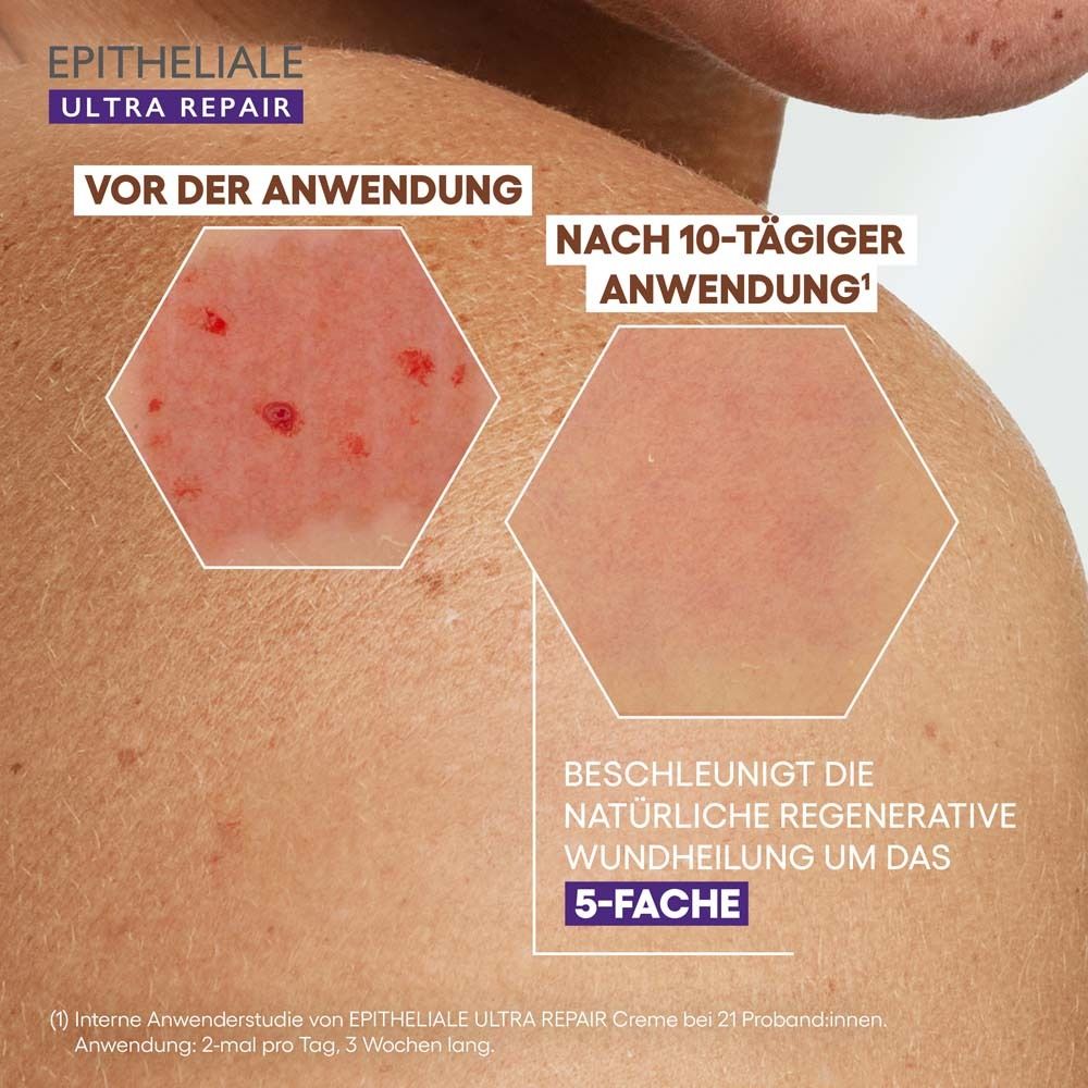 Hautvergleich: Vor und nach 10 Tagen Anwendung. Text: Beschleunigt die Wundheilung um das 5-fache. A-DERMA EPITHELIALE ULTRA REPAIR.