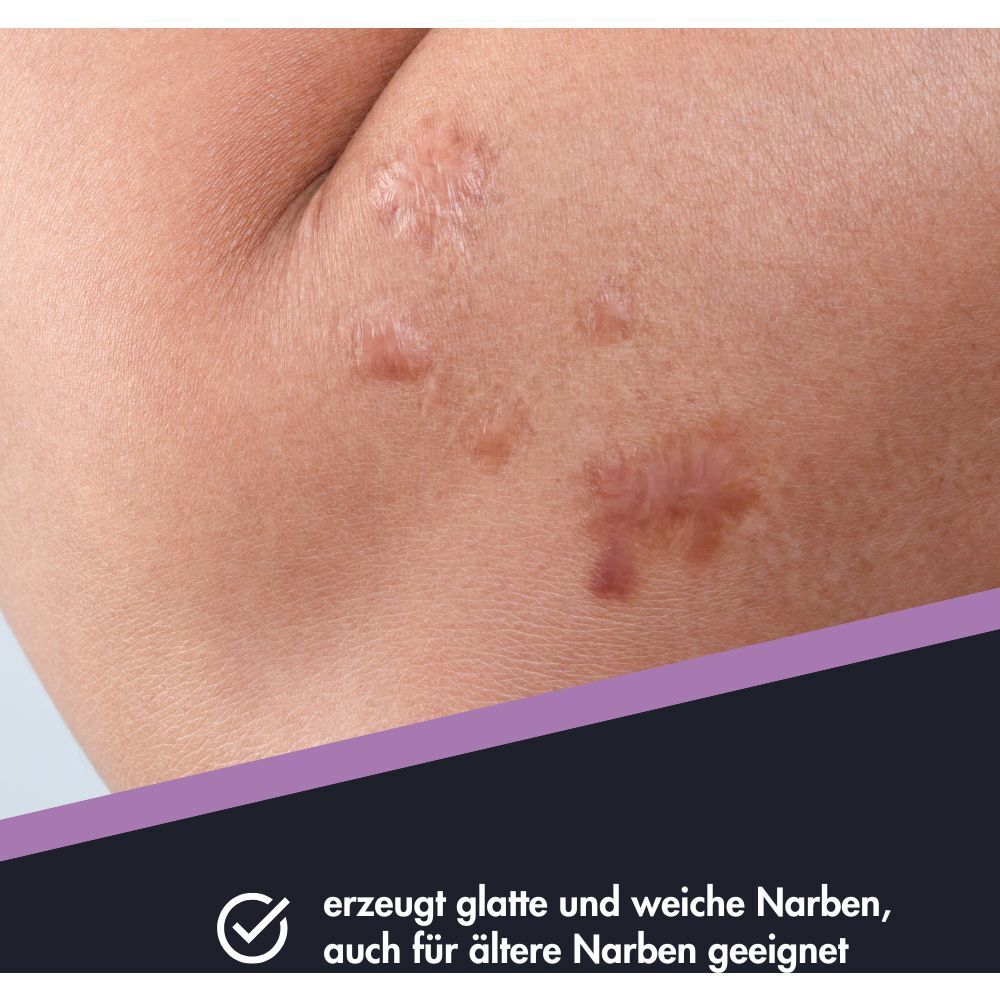 Nahaufnahme von Narben am Arm. Ensbona Narbenpflege macht Narben weicher und glatter.