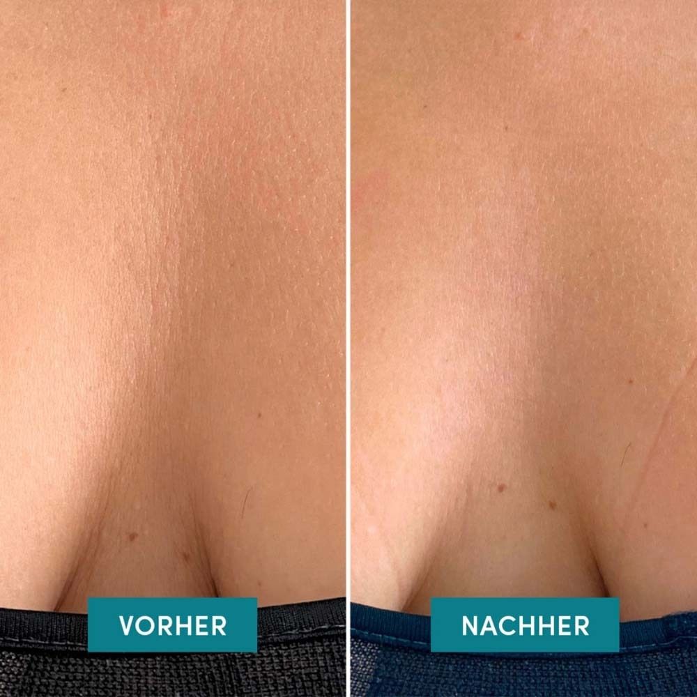 Vorher-Nachher-Vergleich von Haut am Dekolleté. Text: Vorher und Nachher. Blaue Balken.