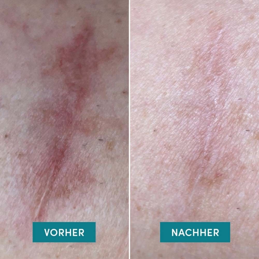 Zwei Nahaufnahmen: Vorher-Nachher-Vergleich einer Narbe. Beschriftung: Vorher, Nachher. Haut mit Narbe.