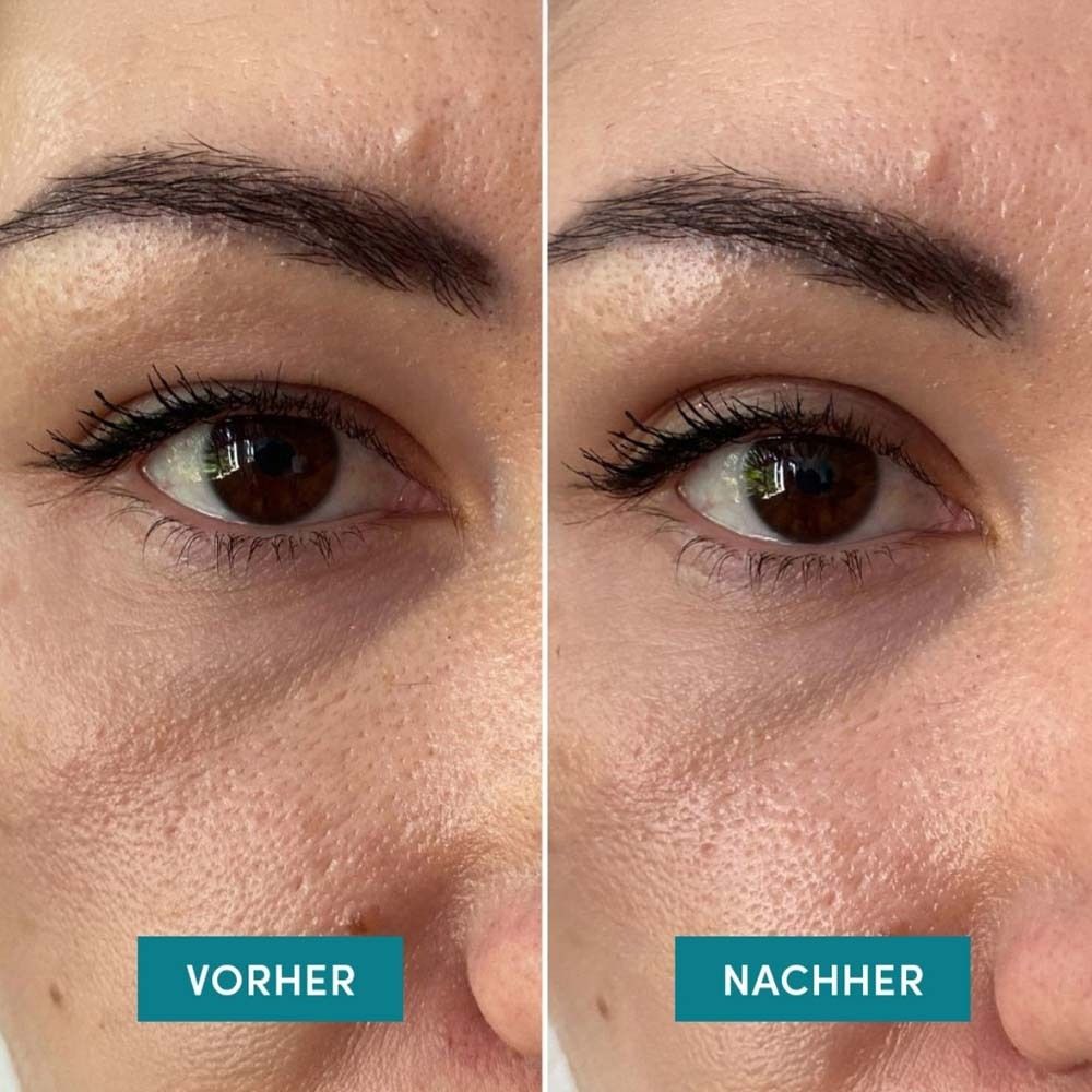 Zwei Augen, links 'VORHER', rechts 'NACHHER'. Vergleich von Hautzuständen.